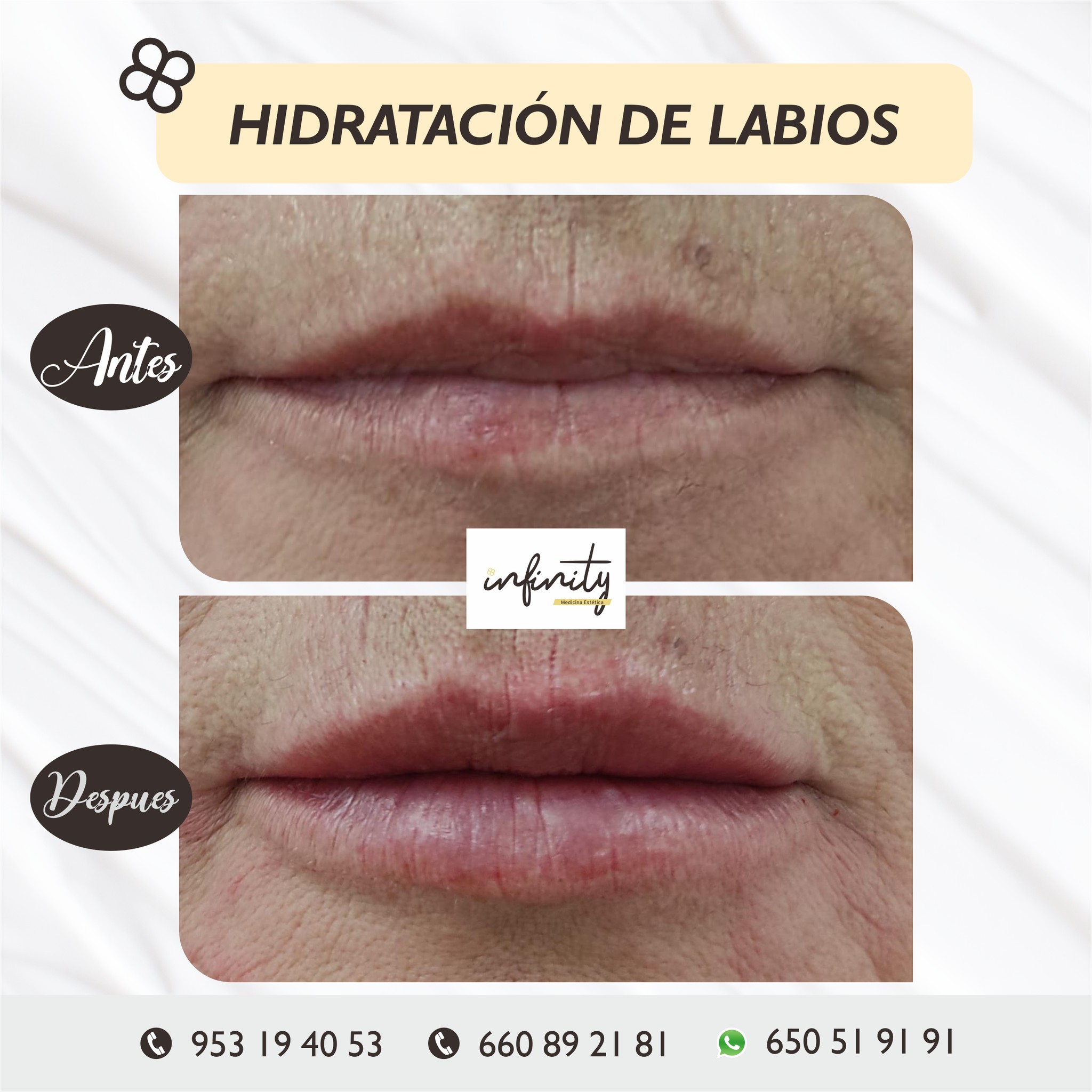 mejora tus labios para tu boda con nuestra hidratacion